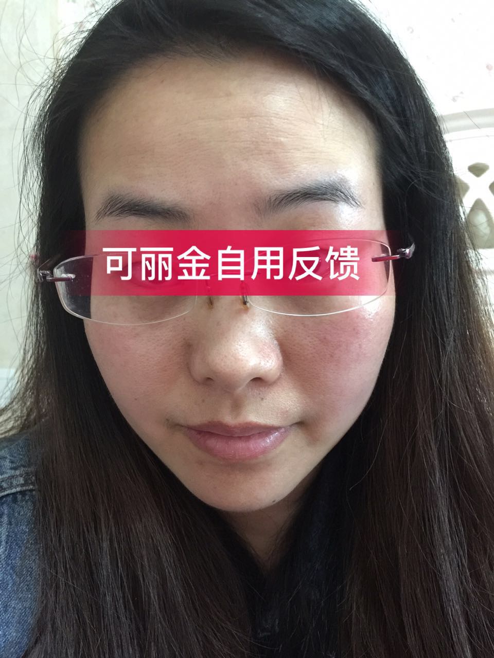 图下这位美女因为卸妆不彻底+暴晒导致皮肤敏感+红血丝…… 坚持使用可丽金半年后成功修复了肌肤屏障，现在 ...