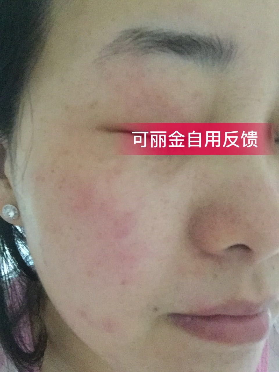 图下这位美女因为卸妆不彻底+暴晒导致皮肤敏感+红血丝…… 坚持使用可丽金半年后成功修复了肌肤屏障，现在 ...