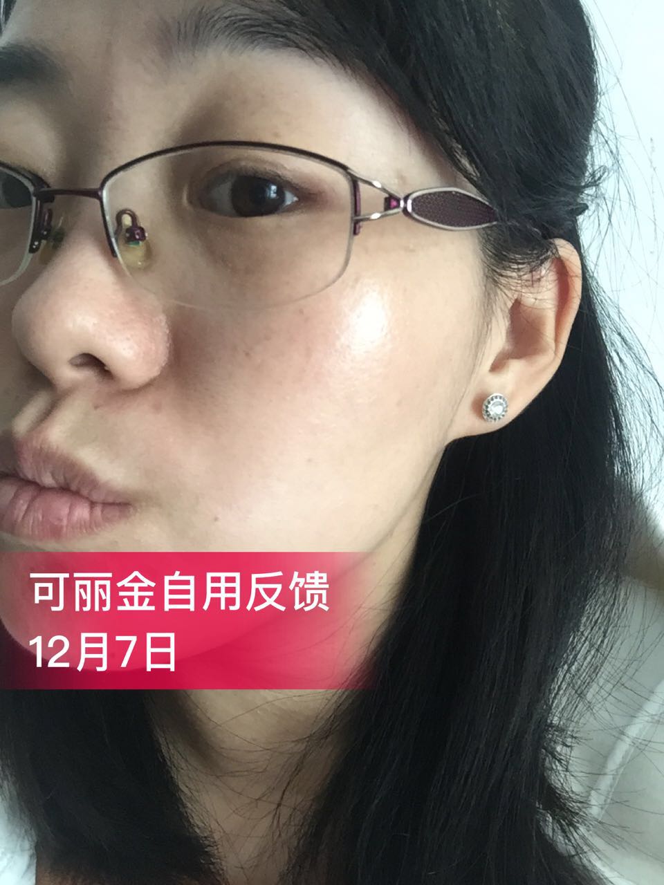 图下这位美女因为卸妆不彻底+暴晒导致皮肤敏感+红血丝…… 坚持使用可丽金半年后成功修复了肌肤屏障，现在 ...