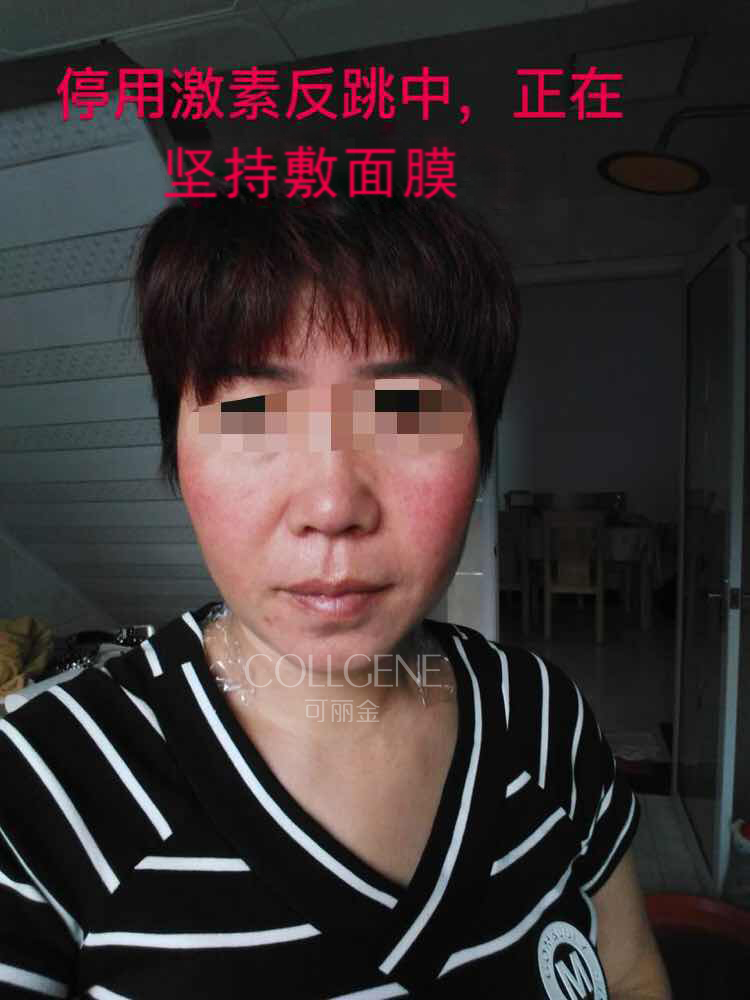 下面这个反馈是来自激素依赖性皮炎患者，她用可丽金之前竟然还在用激素护肤品用可丽金时出现过一次激素反跳 ...
