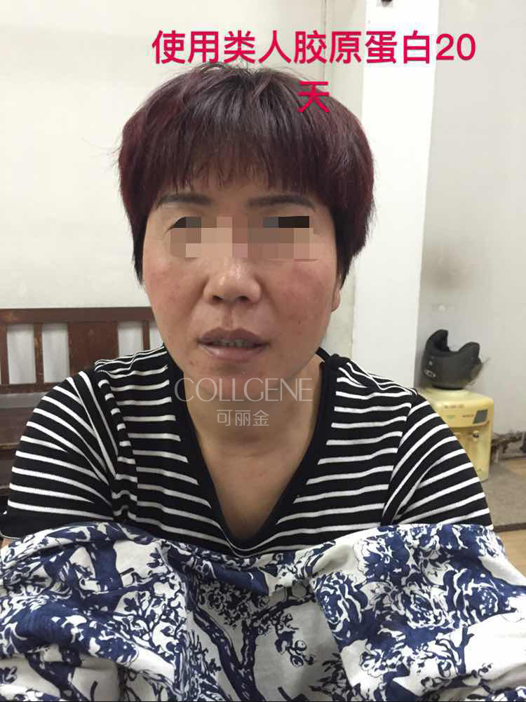 下面这个反馈是来自激素依赖性皮炎患者，她用可丽金之前竟然还在用激素护肤品用可丽金时出现过一次激素反跳 ...