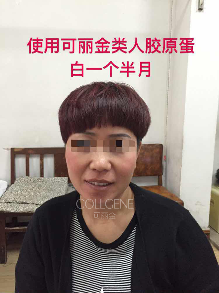 下面这个反馈是来自激素依赖性皮炎患者，她用可丽金之前竟然还在用激素护肤品用可丽金时出现过一次激素反跳 ...