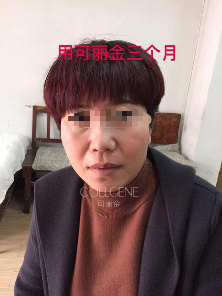 下面这个反馈是来自激素依赖性皮炎患者，她用可丽金之前竟然还在用激素护肤品用可丽金时出现过一次激素反跳 ...
